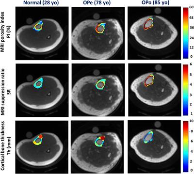 MRI-based porosity index (PI) and suppression ratio (SR) in the tibial cortex show significant differences between normal, osteopenic, and osteoporotic female subjects